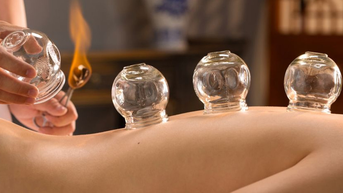 Cupping Therapy Worcester